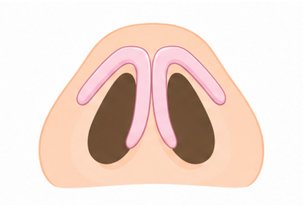 Type1 수술 전